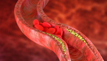 Ischemic heart disease - causes, symptoms and treatment