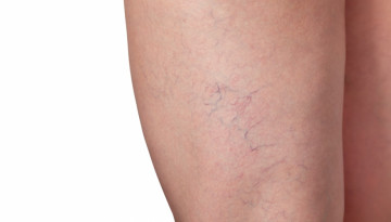 Microsclerotherapy of vascular "asterisks, reticulum, spiders"
