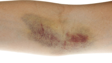 Hematoma drainage and other methods of its treatment. Consequences of hematomas