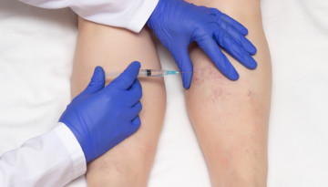 Recommendations to the patient before sclerotherapy