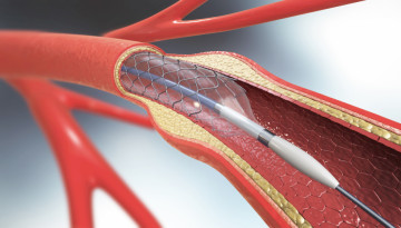 Types of endovascular surgery. Features, indications, benefits