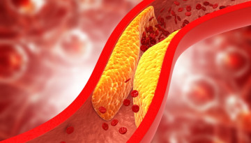 Symptoms of atherosclerosis of the vessels of the neck, head, coronary arteries