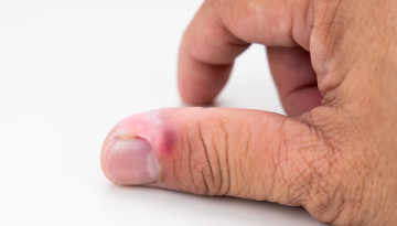 Finger paronychia: conservative and surgical treatment