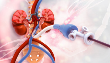 Causes of arteriovenous fistula formation, its treatment