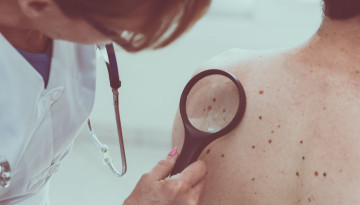 Early Symptoms of Skin Melanoma - Information for Patients