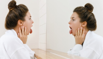 Tongue cancer