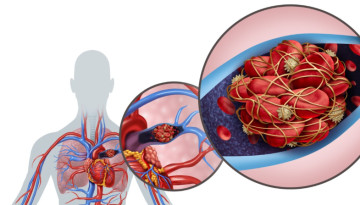 Causes of development, manifestations and treatment of pulmonary embolism