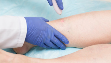 Varicose veins: operations, treatment and postoperative features