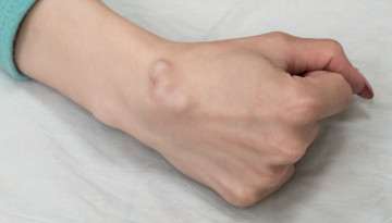 Что такое гигрома. Лечение гигромы кисти руки и других локализаций
