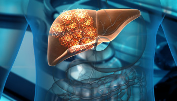 Liver cancer