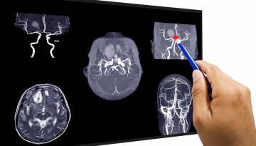 Ангиография сосудов головного мозга – важная информация для пациентов