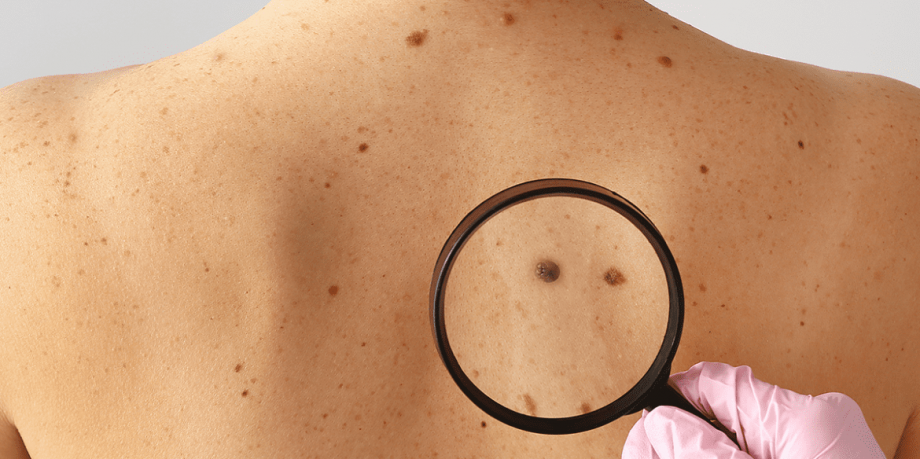 Information for patients with skin cancer