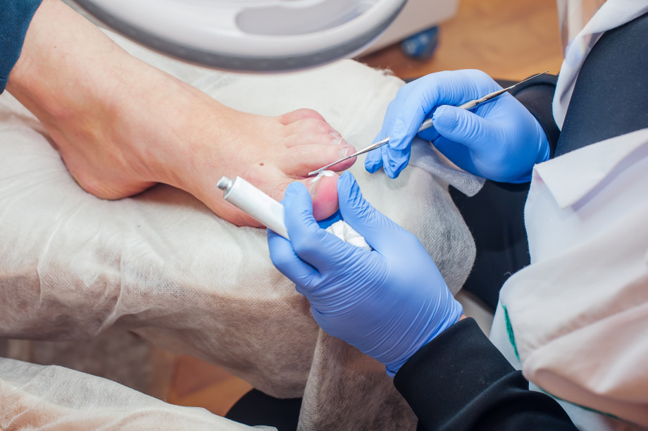 Causes, signs and treatment of ingrown toenail. Laser removal