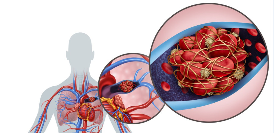 Причини розвитку, як проявляється і як проходить лікування тромбоемболії легенів