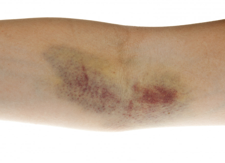 Hematoma drainage and other methods of its treatment. Consequences of hematomas