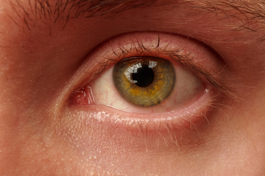 Causes, symptoms and treatment of blepharitis