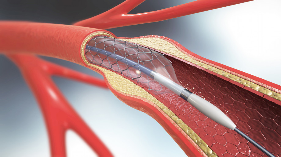 Types of endovascular surgery. Features, indications, benefits