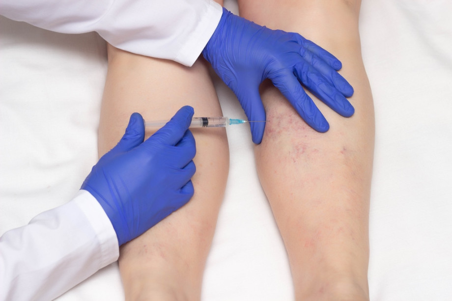 Vein sclerotherapy - the essence of the procedure, types of drugs, rehabilitation