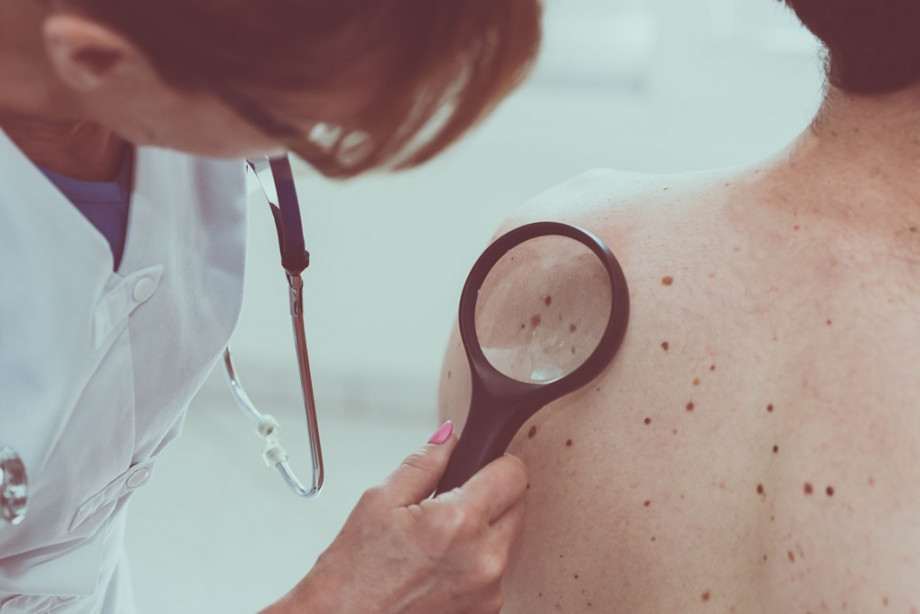 Ранні симптоми меланоми шкіри – інформація для пацієнтів