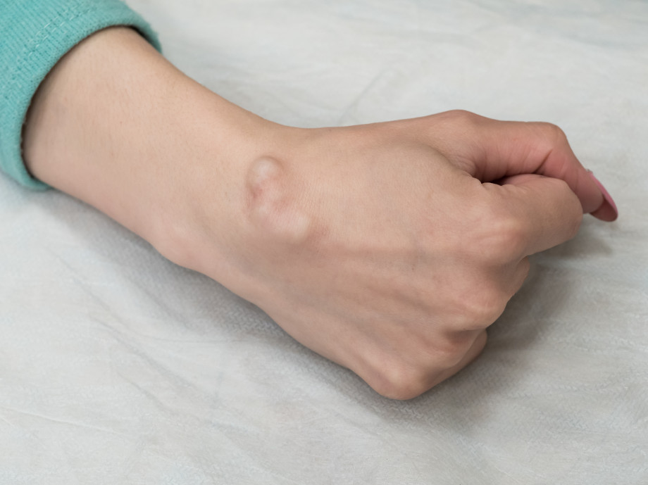 What is hygroma. Treatment of cyst hygroma of the hand and other localizations
