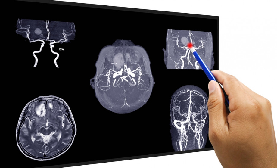 Ангіографія судин головного мозку – важлива інформація для пацієнтів