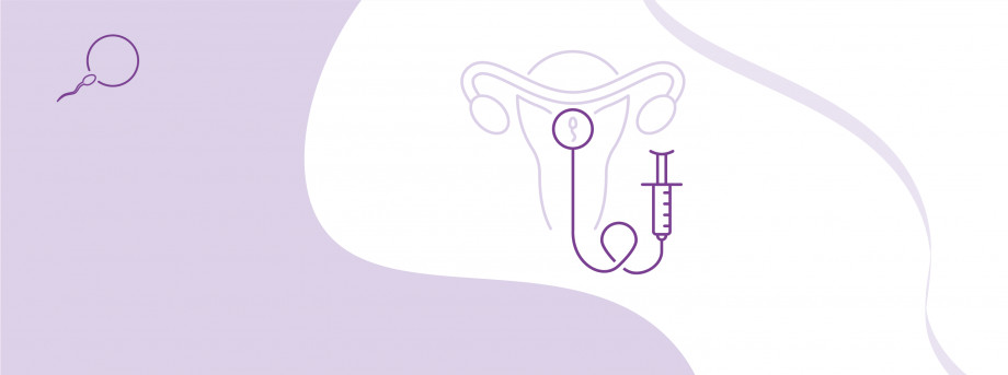 IVF program with drug stimulation and embryo transfer